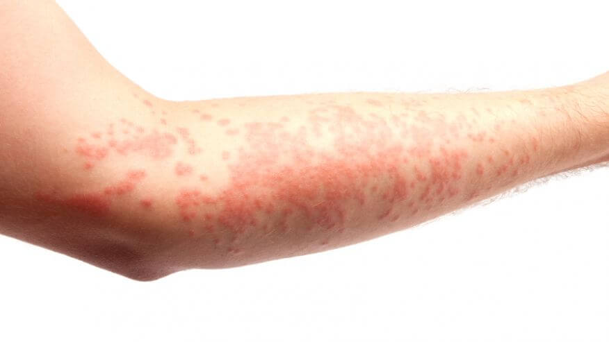 L'eczemas est une dermatose sèche qui touche dès le plus jeune âge