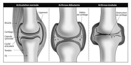 L'arthrose une des nombreuses maladies qui touchent les articulations