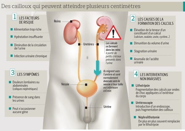 calcul rénal