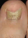 mycose de l'ongle et fongiderme