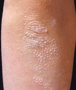 Le psoriasis est une inflammation de la peau qui se multiplie et desquame.