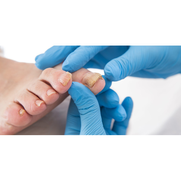 Remède naturel pour les mycoses de l'ongle et du pied