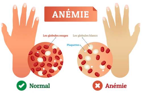 Froid aux mains à cause de l'anémie