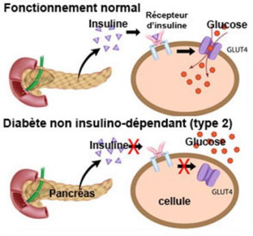 Le mécanisme du diabète de type 2 - www.phyto-soins.com