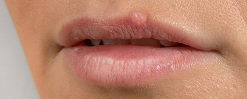 Les huiles essentielles contre les boutons de fièvre ou herpès labial