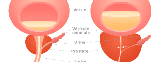 Trouble de la prostate: faire baisser les PSA grâce aux plantes