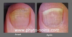 Traitement naturel mycose des ongles de pied -  Remède de grand mère