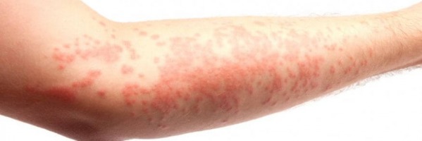 Traitement naturel de l'Eczéma (dermatite atopique)